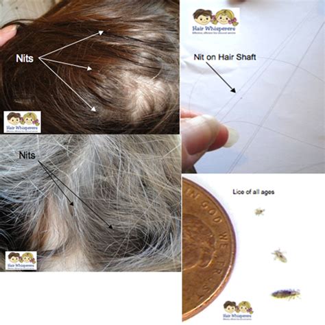 Head Lice Moving