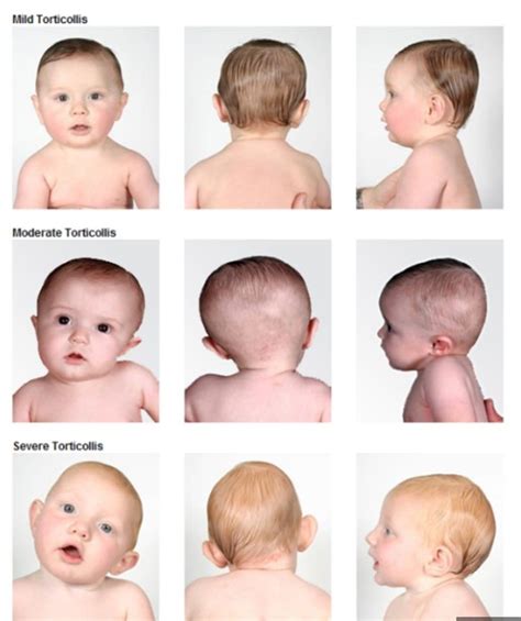 Head Tilting in Babies