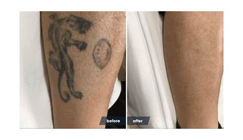 Healing Process Of Laser Tattoo Removal The Removery
