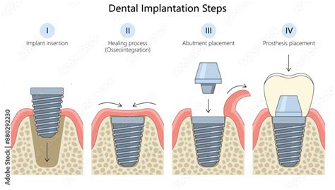 Healing Abutment Procedure