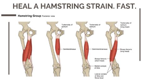 Effective Strategies for Fast Healing Hamstring Strain Recovery