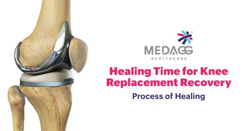How Long Does It Take to Walk Again? Understanding the Healing Time for Knee Replacement Surgery