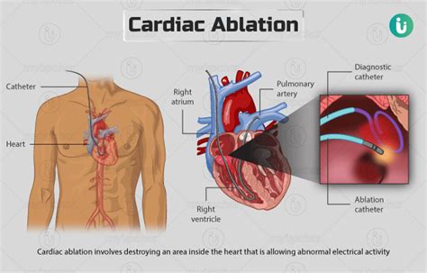 Heart Ablation Surgery Cost