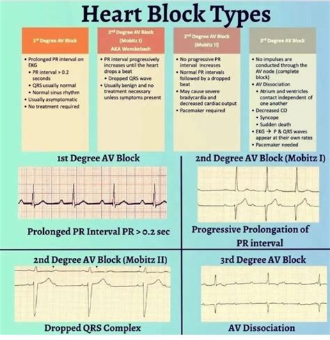 Heart Block Definition Quizlet