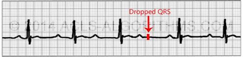 Heart Block Dropped Qrs