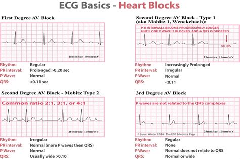 Heart Block Ecg Vs Normal