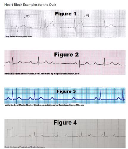 Heart Blocks Quiz