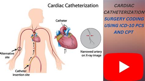 Heart Catheterization Icd 10 Code