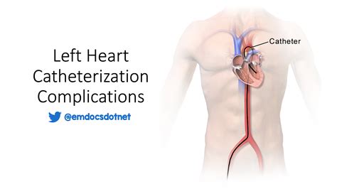 Heart Catheterization Procedure Complications