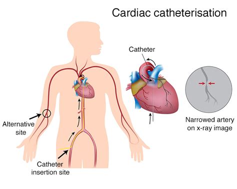 Understanding Heart Catheterization Purpose: A Lifesaving Diagnostic Tool