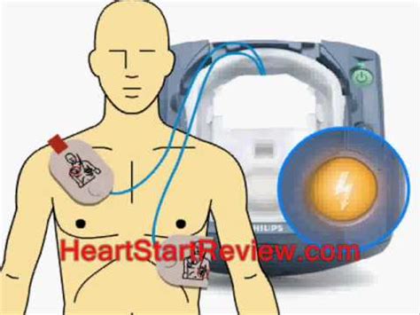 Heart Defibrillator Life Expectancy