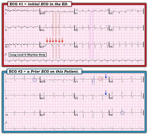 heart failure on ekg