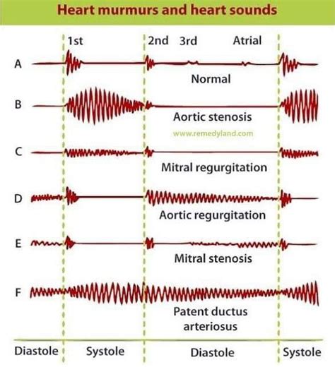 Heart Murmur Vs Heart Flutter