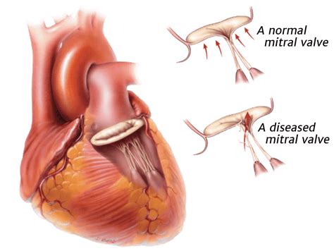 Heart Valves Malfunction