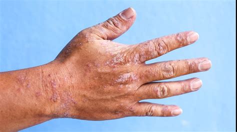 heat rash pictures on hands