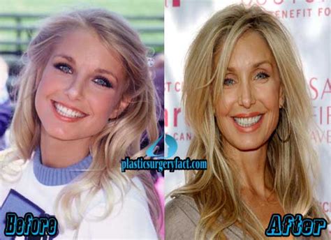heather thomas plastic surgery