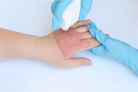 heating pad burn treatment prevention