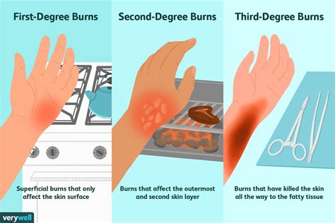 heating pad burn treatment stages