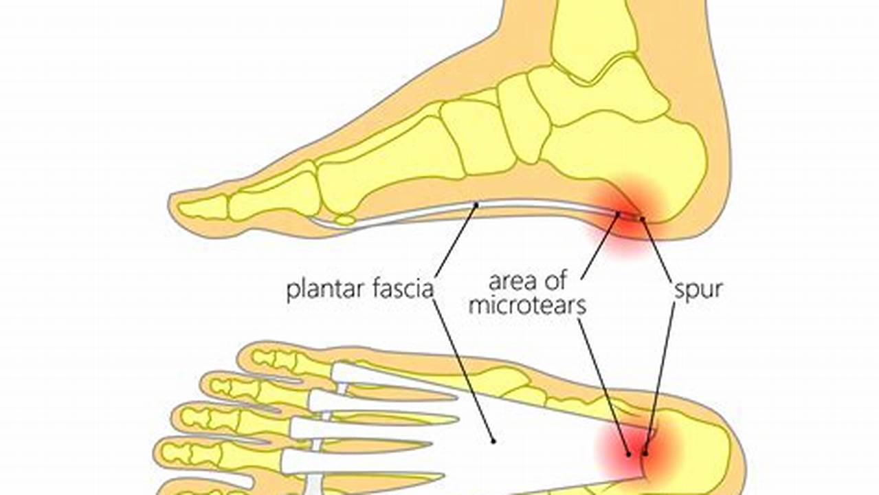 Heel Pain Diagram: A Visual Guide to Identifying and Treating Heel Pain