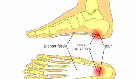 Heel Pain Plantar Fasciitis Treatment s You Can Do At Home For