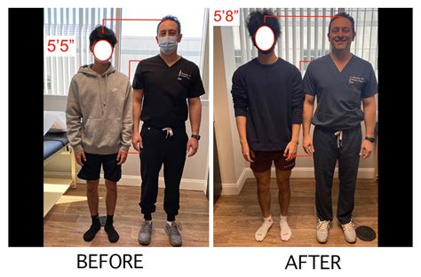Unlock Confidence: Height Surgery's Instant Transformation Magic