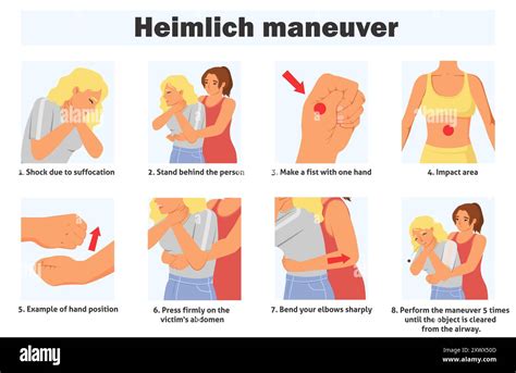 Ilustrasi Heimlich Maneuver