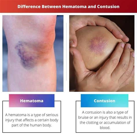 Hematoma vs Bruise: What's the Difference and How to Tell Them Apart