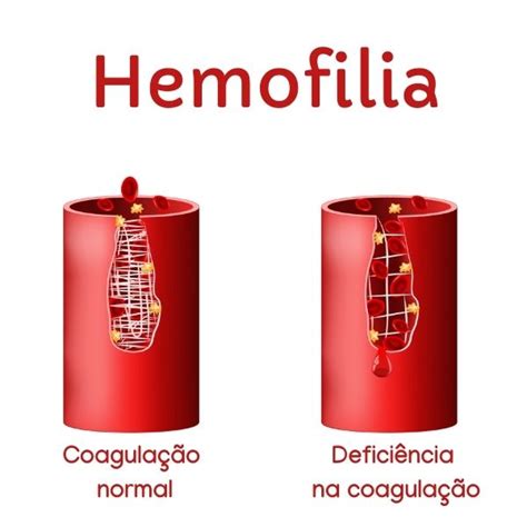 hemofilia a e b artigo