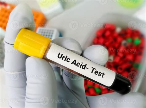 Hemolyzed Sample For Uric Acid