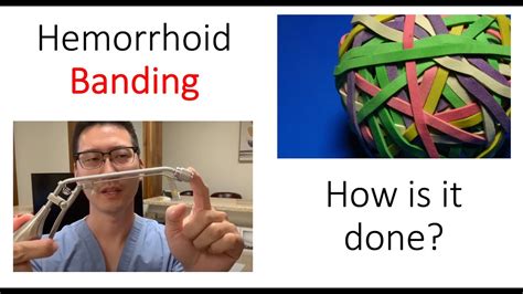 hemorrhoid banding treatment