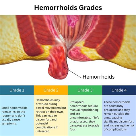 Hemorrhoid External Grade
