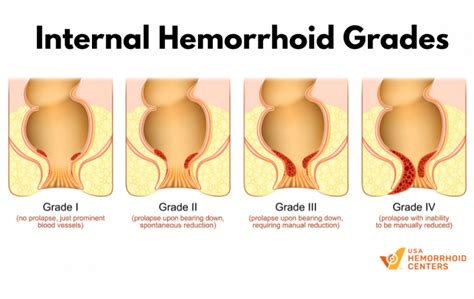 Hemorrhoid Grade 2