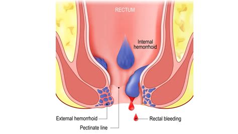 Hemorrhoids External Vs Internal