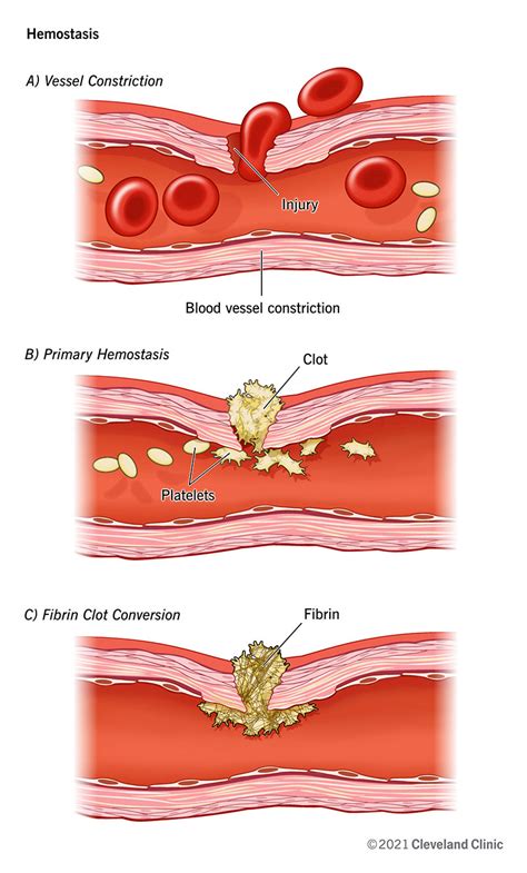 Hemostatic Therapy Definition