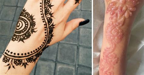 Henna Tattoo Allergy Medicine / Tattoos can cause severe