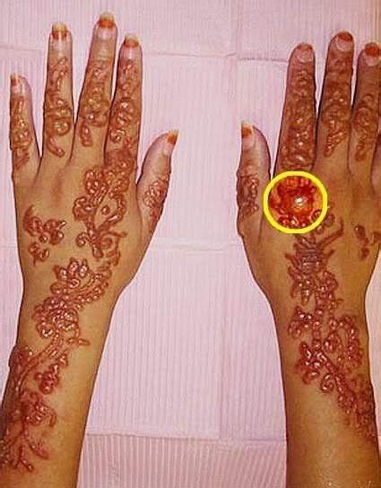 Black Henna Tattoo Reaction Treatment Black henna