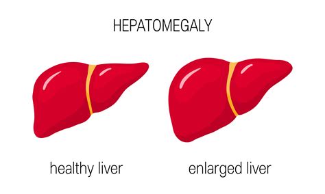 hepatitis a hepatomegaly