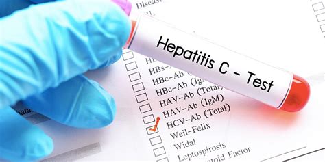 Accurate Diagnosis: Understanding the Hepatitis HCV Test Process