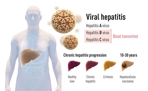 hepatitis non viral adalah