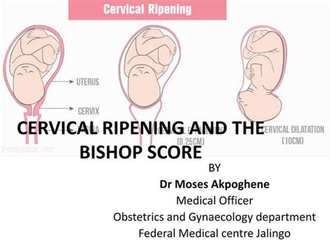 her bishop score and cervical ripening