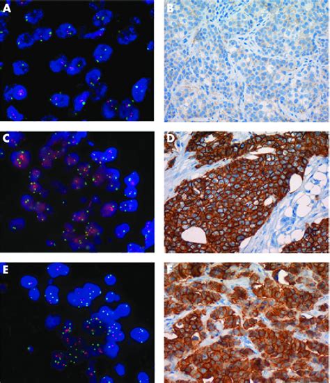 her2 ihc and fish