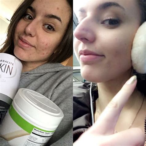 herbalife collagen before and after
