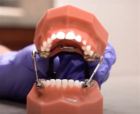 Herbst Appliance Does