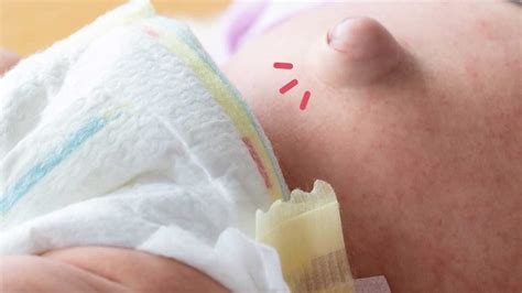 Hernia Pada Bayi: Fakta Penting Yang Harus Diketahui