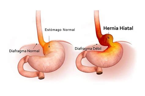 Understanding and Managing Hernia de Hiato Effectively Today
