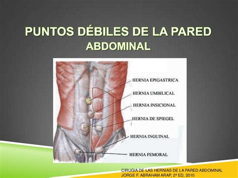 hernia de pared abdominal gpc