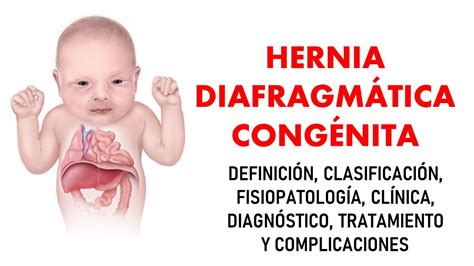 hernia diafragmatica congenita gpc