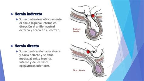 hernia directa e indirecta