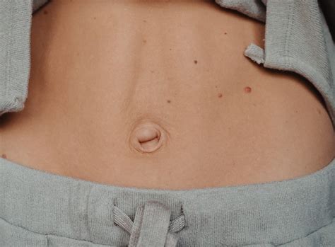 Understanding Hernia in Belly Button: Causes, Symptoms, and Treatment Options