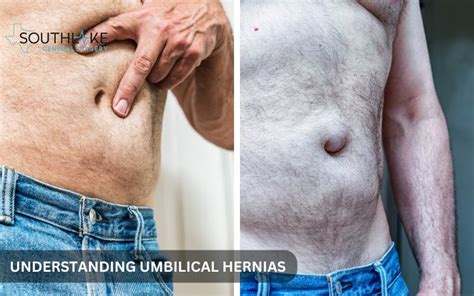 Understanding and Addressing a Hernia in Navel: Causes, Symptoms, and Treatment Options